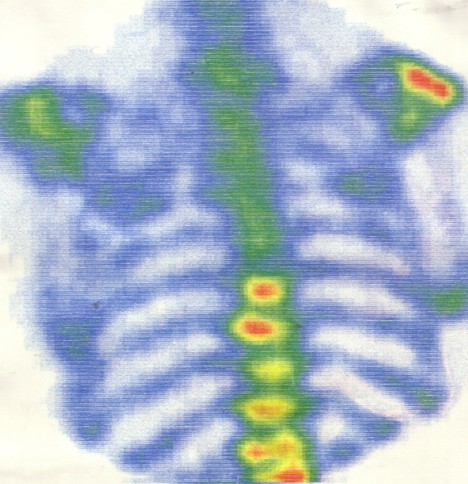 Mit Technetium-99m aufgenommenes Knochenszintigramm